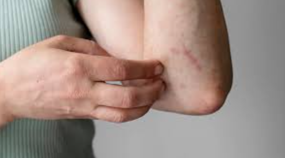 Management Of Nagin Disease: Dietary Tips And Lifestyle Adjustments​